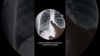 Как выглядит пневмония на рентгене