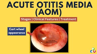Acute Otitis Media | AOM | ASOM