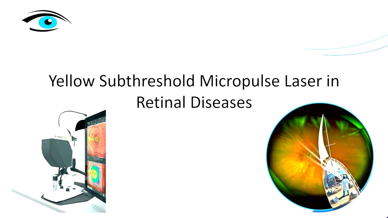 LASER NAVILAS. Première partie.