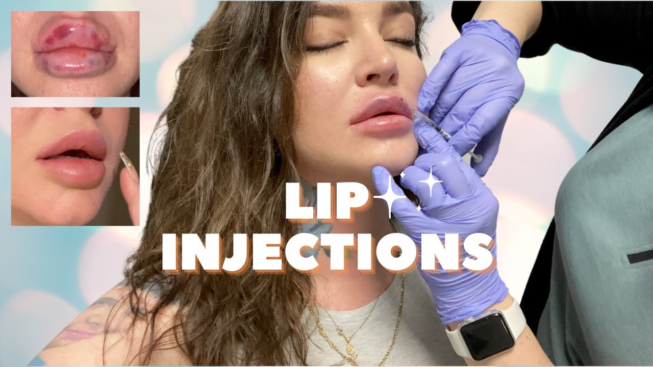 LIP FILLER before, during and after 💋 FULL HEALING EXPERIENCE | RUSSIAN TECHNIQUE