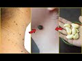 Remove skin tags in 1 night || natural skin tag removal remedy || Effective remedy for mole removing