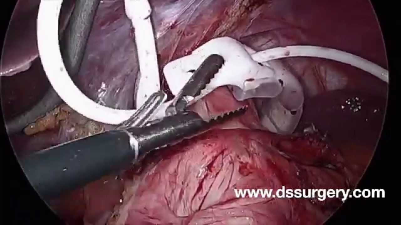 Lap Band Removal YouTube