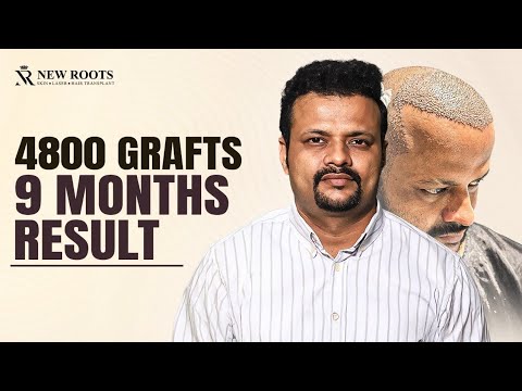 Hair Transplant in Mumbai: Best Hair Transformation 😳 | Cost of Hair Transplant in Mumbai