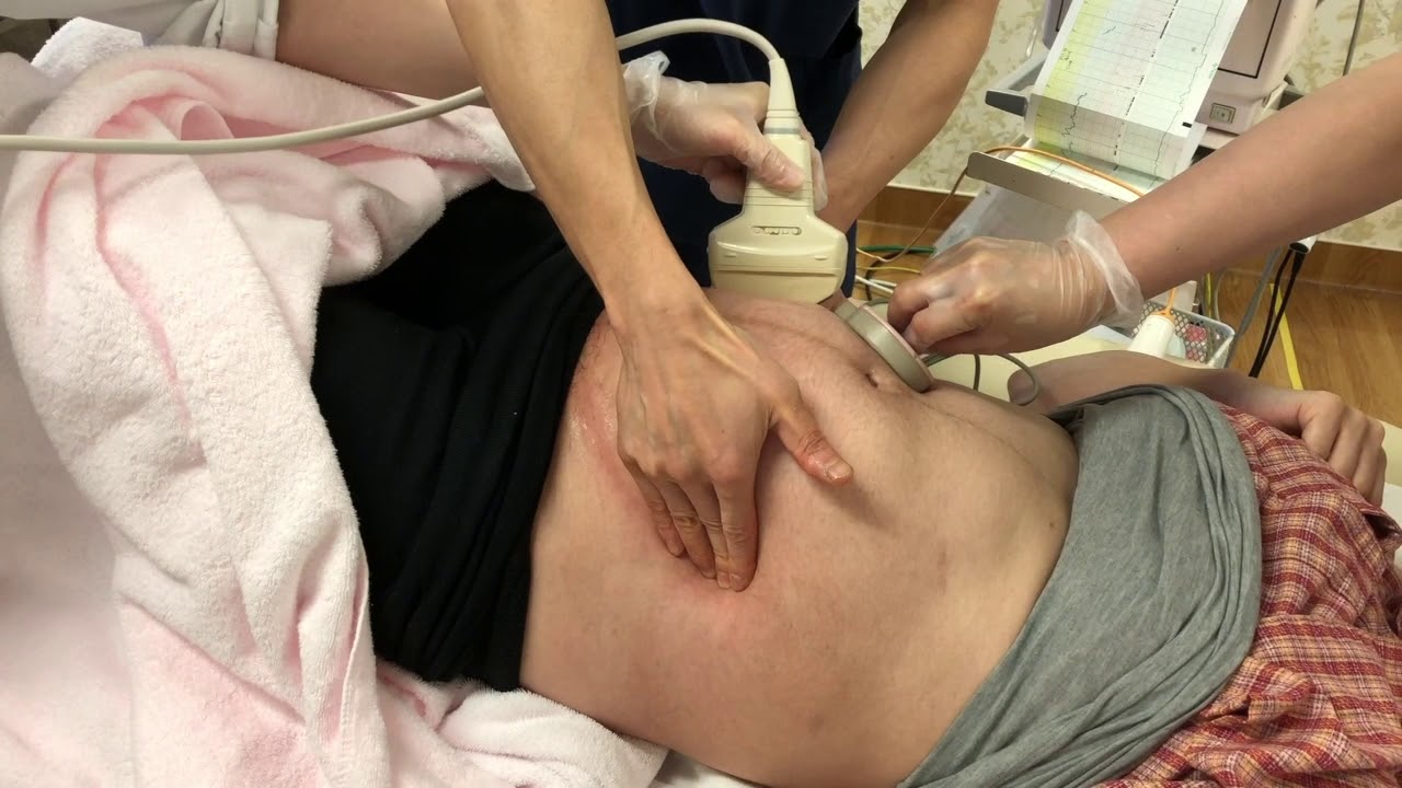 逆子のお産 外回転術と経膣分娩 Youtube