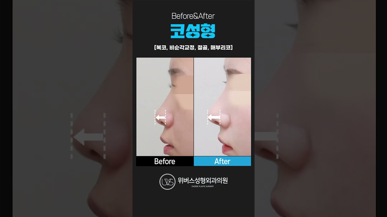 Виверс гоо сайхны мэс заслын эмнэлэг: Хамрын гоо сайхны мэс засал өмнө ба дараа 👏🏻👍🏻