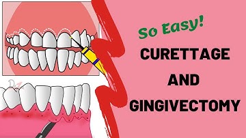 Gingival Curettage and Gingivectomy | PERIODONTOLOGY