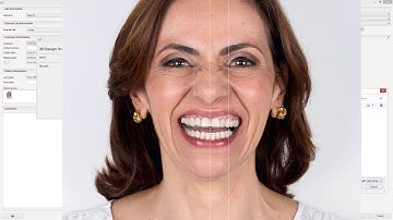 3Shape Dental System Smile Design アプリケーションと RealView エンジンを使用して設計する方法