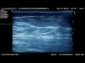 Ildefined Margin Axillary Lipoma 2025 06 19 Ildefined Margin Axillary Lipoma 2025 06 19