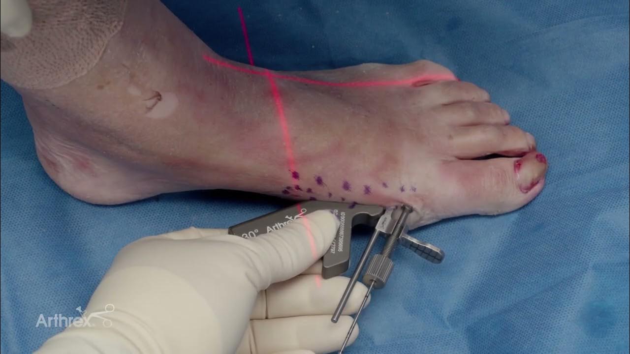 arthrex-minimally-invasive-bunionectomy-with-mis-parallel-guides-youtube