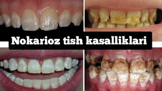 NOKARIOZ TISH KASALLIKLARI/ НОКАРИОЗ ТИШ КАСАЛЛИКЛАРИ NOKARIOZ TISH KASALLIKLARI/ НОКАРИОЗ ТИШ КАСАЛЛИКЛАРИ
