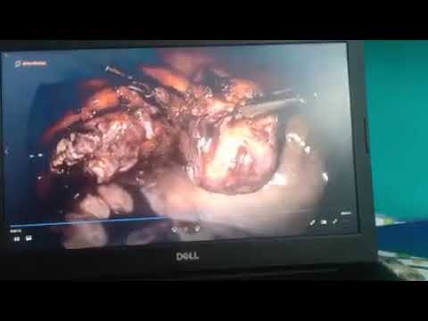 Clinical video 06 thumbnail