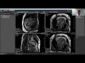 How to integrate strain quantification into your clinical workflow 2019