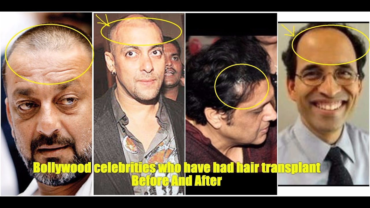 Hair Transplant is in Fashion for Bald Celebrities  Ak Clinics