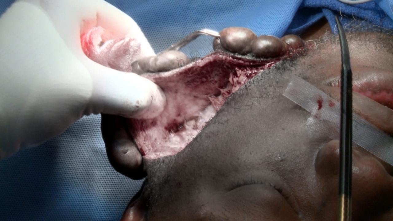 facial keloid cyst Teen couples gallery