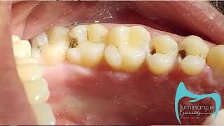 تسوس الأسنان اخطر مما نتوقع   Tooth decay is more dangerous than we expect