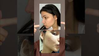 My acne journey part-2  #acne #acnecauses #fungalacne #acnetips #acnetreatment #pimple