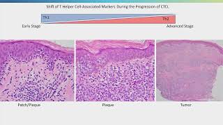 Update on Cutaneous T-Cell Lymphoma | LRF Webinars