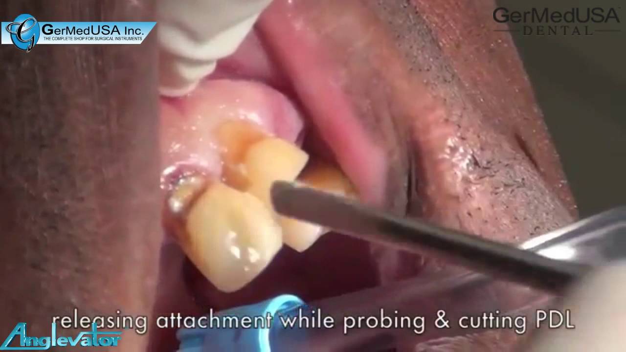 Anglevator multiple root tip extractions YouTube