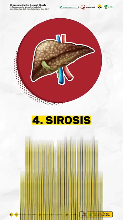 Beberapa Gangguan Pada Organ Hati Yang Perlu Diwaspadai #hati #sirosis #hepatitis #fibrosis