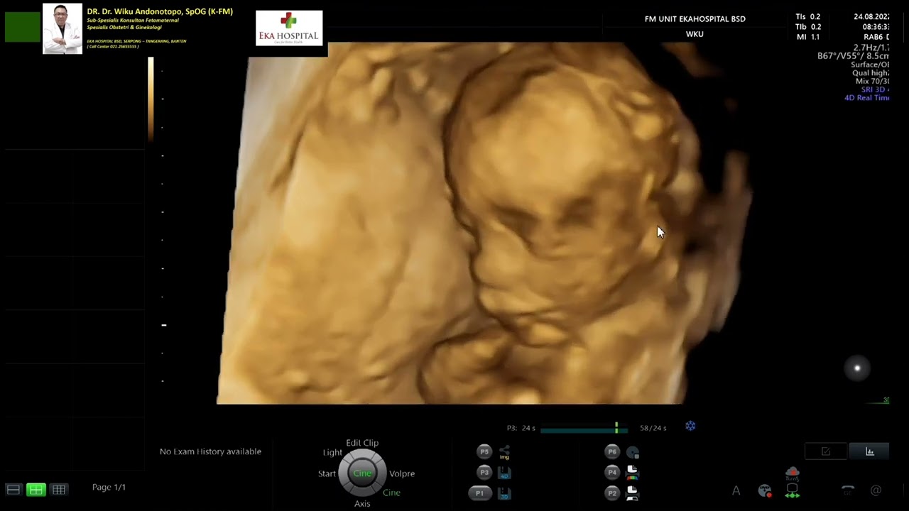 Trisomi 21 - Hygroma Colli (Dr Wiku Andonotopo)