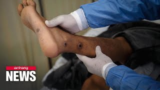 Monkeypox cases jumped 20% in the last week to 35,000 across 92 countries: WHO