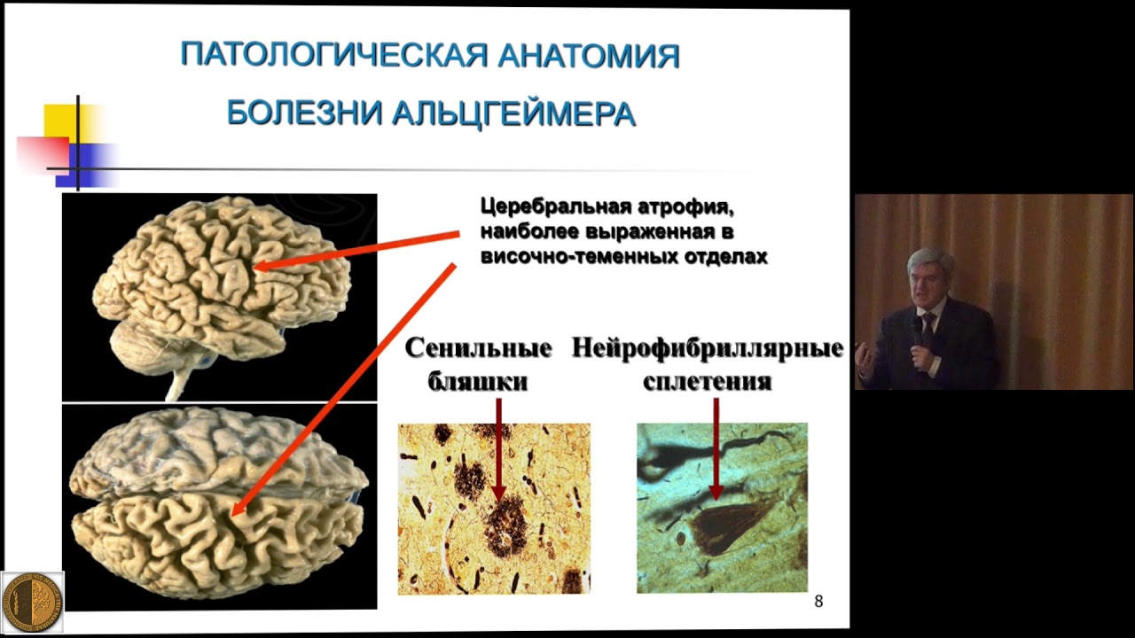 Атрофия мозга у взрослого