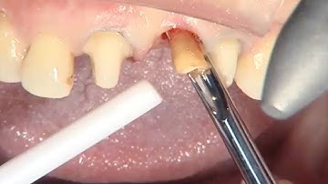 IPS e max® CAD Clinical Advantages & Procedures