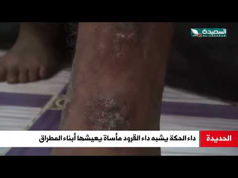 داء خطير يشبه داء القرود ينتشر في منطقة المطراق في الحديدة ومناشدات لانقاذهم