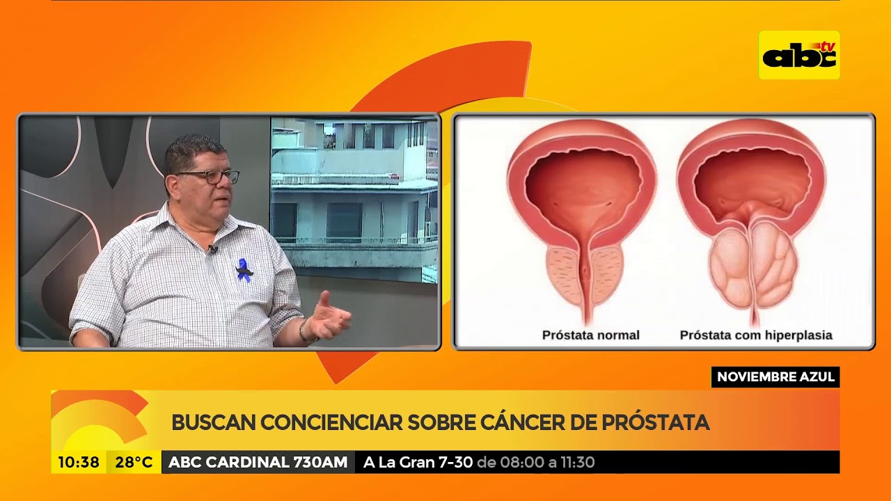 hiperplasia de próstata bnox hiperplasia de próstata bnox