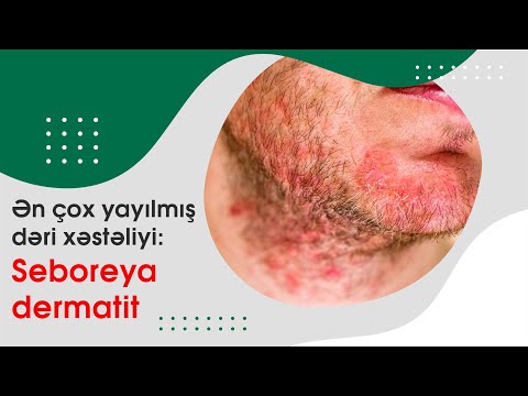 Video: Xroniki aktinik dermatit nədir?