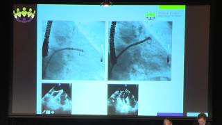 David Meerkin & Ignacio Cruz - Case Examples -  Challenges in closing varying LAA morphologies