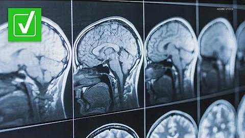 Yes, dementia is fatal. A neurologist explains why