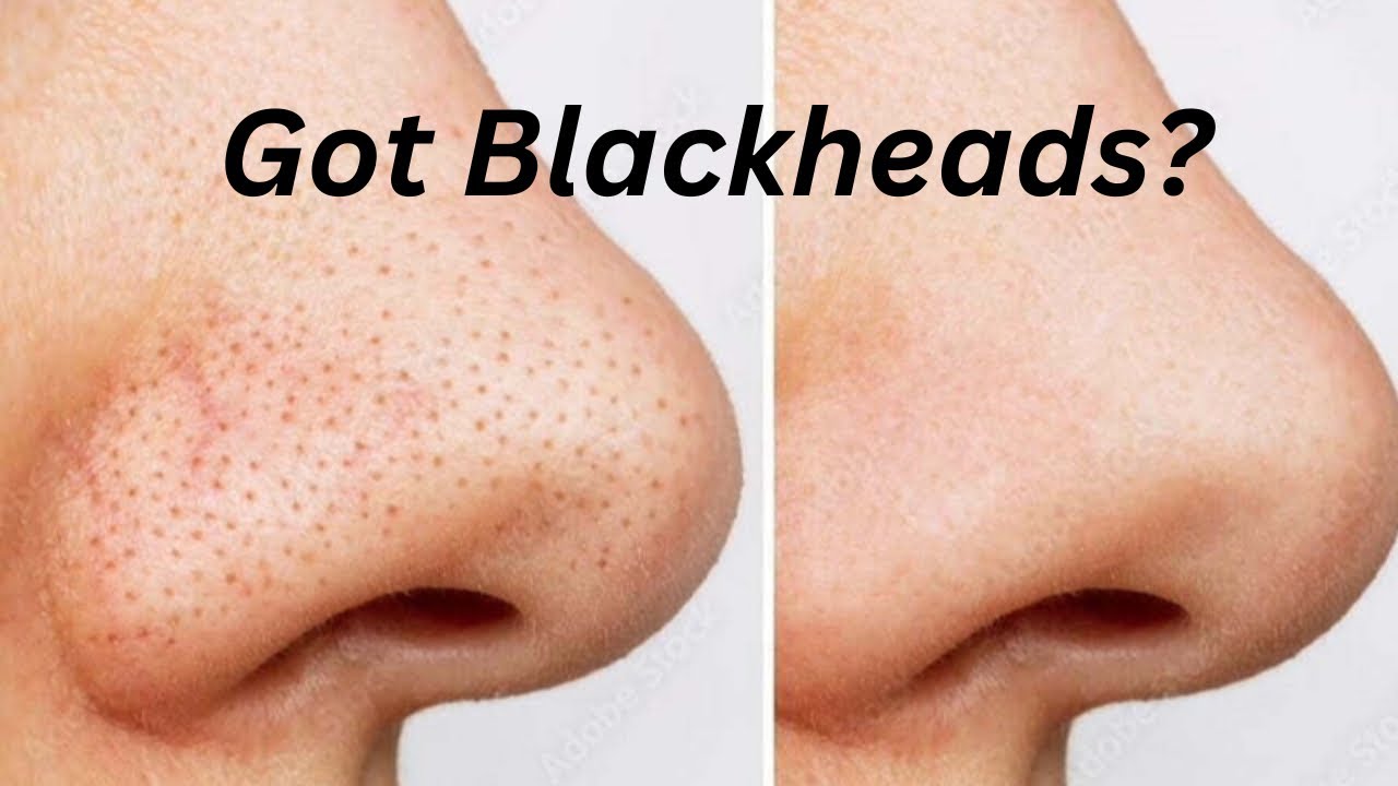 Crazy Hack To Remove Blackheads YouTube