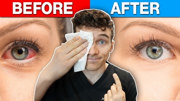 Best Eye Allergy Relief at Home for Red Itchy eyes