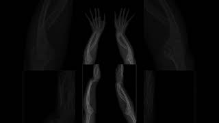 Madelung Deformity X Ray | Positive Ulnar Variance #shorts