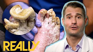 'This Is The Worst Case Of Toe Nail Fungus That I've Seen' | My Feet Are Killing Me