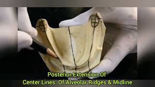 Marking of Important Anatomical Landmarks to Fabricate Mandibular Occlusal Rim