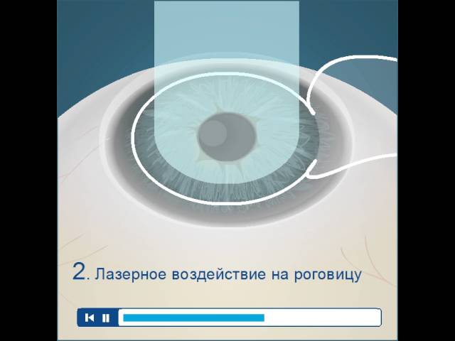 ЛАСИК (лазерный кератомилез)