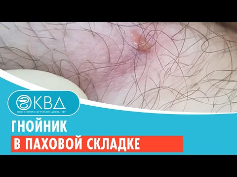🙁 Гнойник в паховой складке. Клинический случай №716