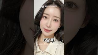 쌍꺼풀수술+코수술+윤곽수술+지방이식 후기 #shorts