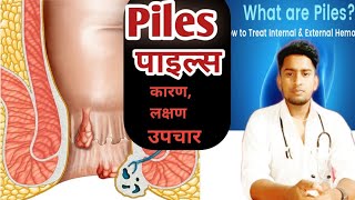 Piles|पाइल्स के हो|causes,sign/symptoms and treatment at home and hospital (Nepali)