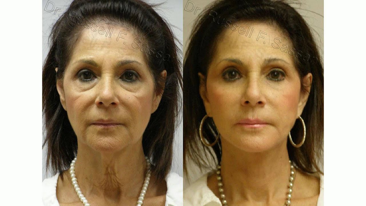 What Can a Facelift Fix? Take Shape Plastic Surgery, P.A. Ft