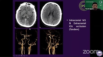 #1.3 Cập nhật chẩn đoán và điều trị đột quỵ thiếu máu não cấp – ThS. BS. Nguyễn Quang Anh