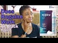 Does Rogaine/Minoxidil work on Black hair? 2 years later / TV Blake Review
