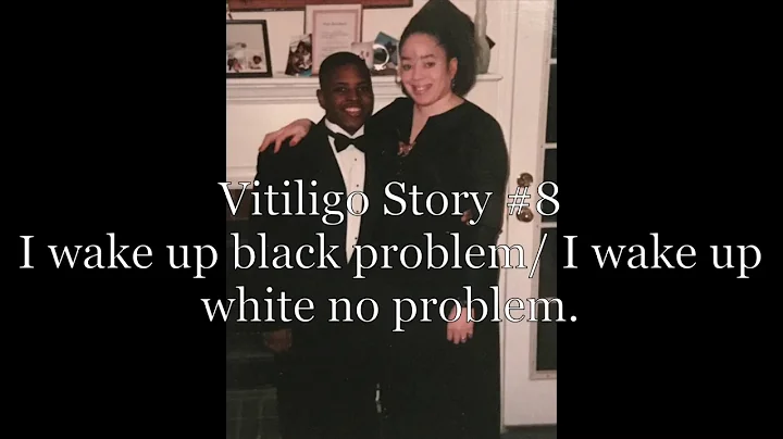 Vitiligo Story #8: I wake up black problem/ I wake...