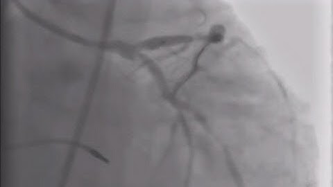 Left Main Stenting