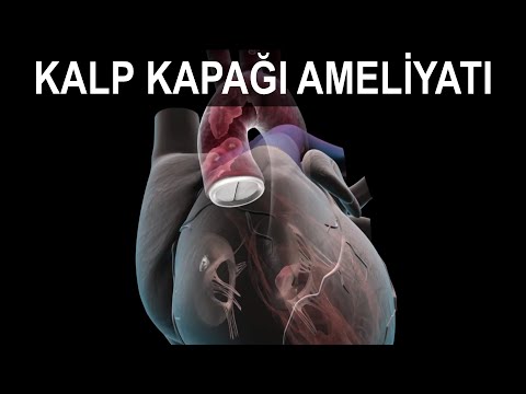 KALP KAPAĞI AMELİYATI | Aort Kapak Ameliyatı