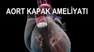 Kalp Kapaği Ameli̇yati Aort Kapak Ameliyatı