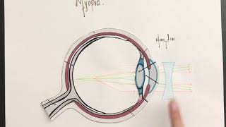 | How to correct refractive errors | Saray Meléndez