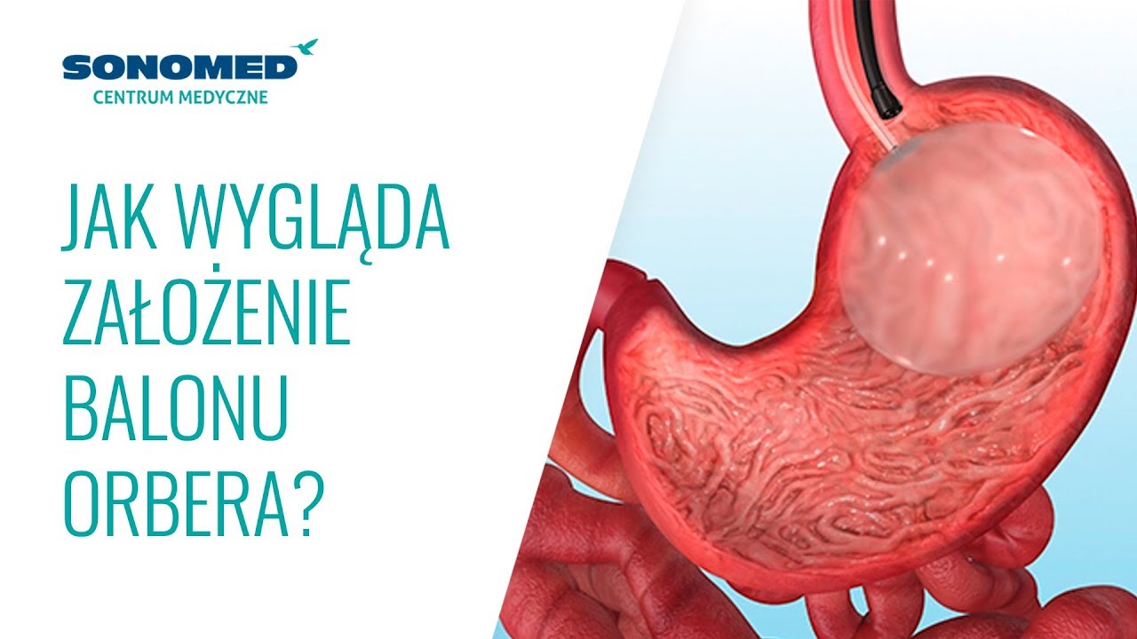 Jak wygląda założenie balonu żołądkowego?